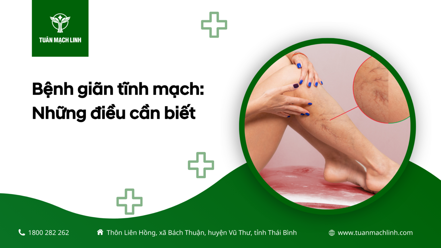 Giãn tĩnh mạch: Những điều cần biết