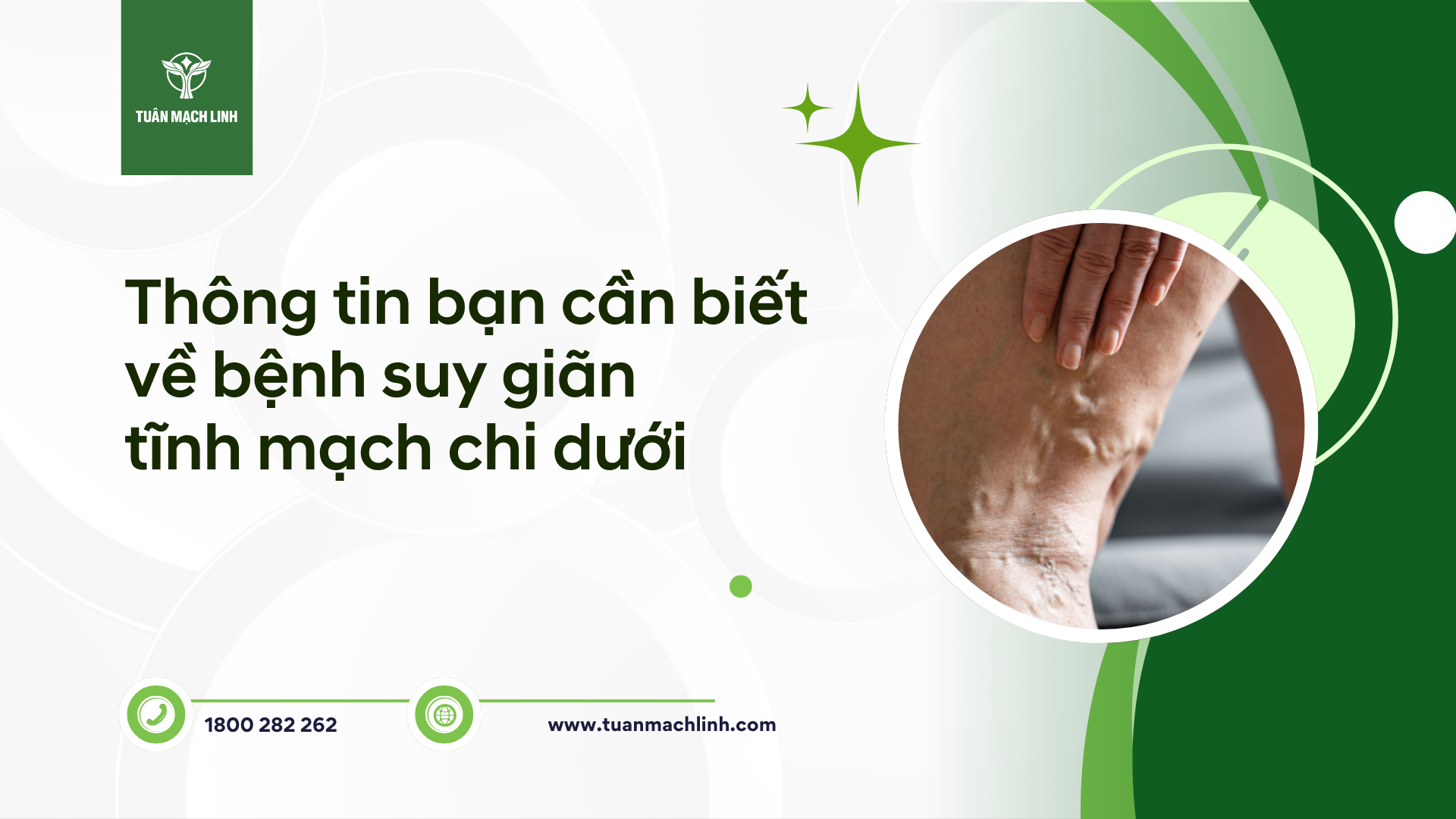 Thông tin bạn cần biết về bệnh suy giãn tĩnh mạch chi dưới